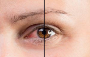 A close-up view of a woman's eye showing the before and after of her dry eye syndrome, left being red and irritated the right side being normal