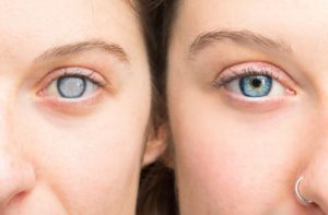Two woman beside each other showing the before and after of cataract surgery