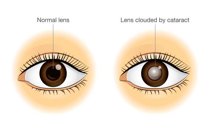 An illustration of what a normal eye looks like versus an eye with a cataract