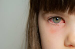 A close-up of a child with red, irritated eyes, signalling pink eye.